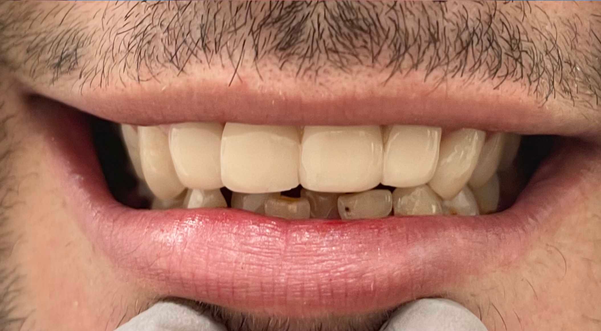 Case 1 after dental treatment