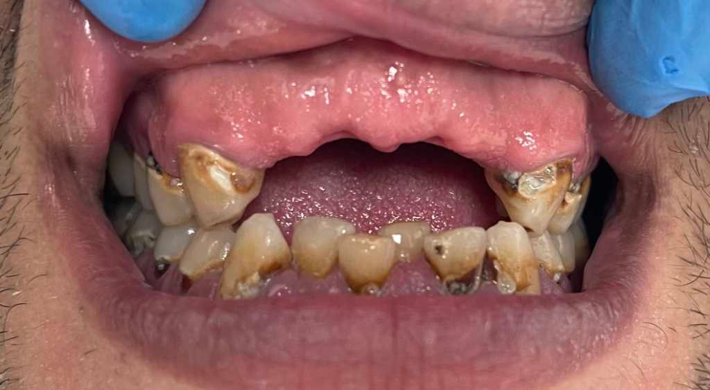 Case 1 before dental treatment