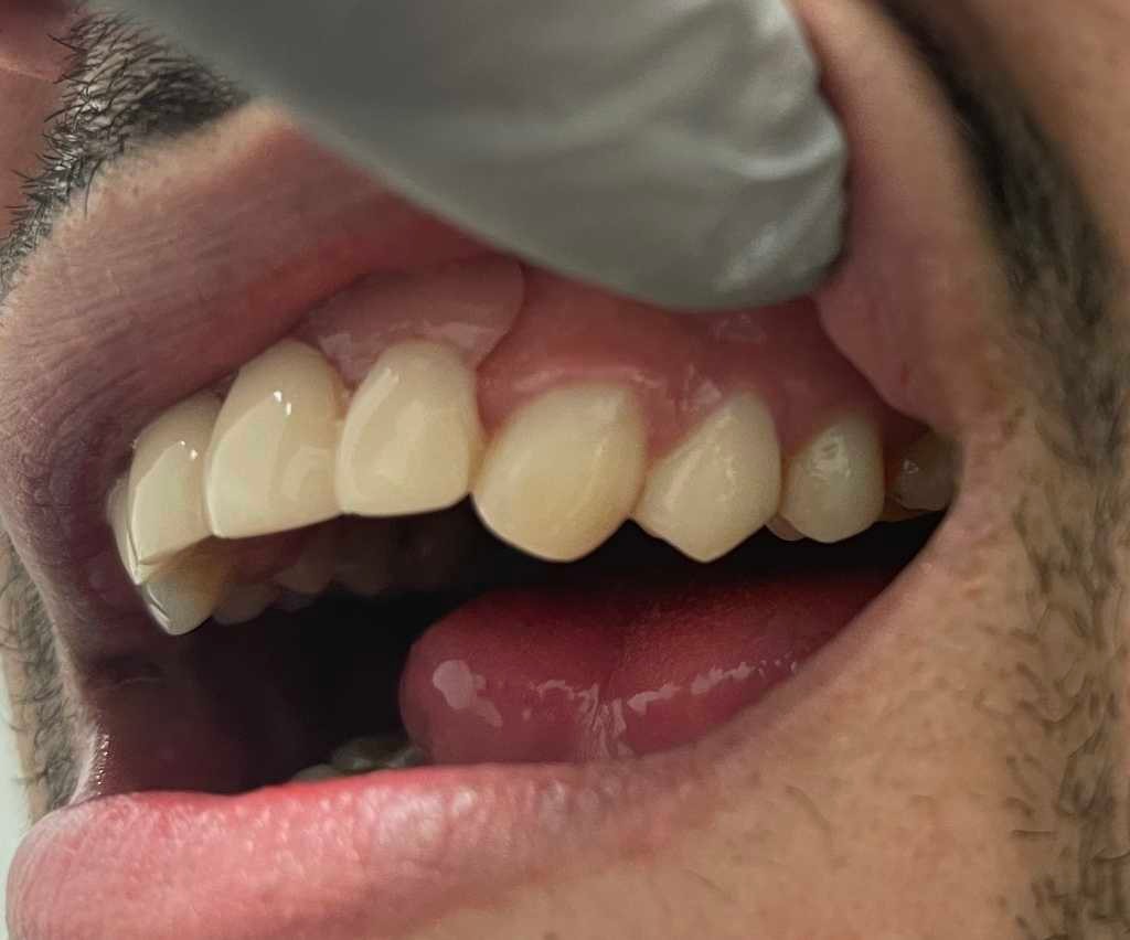Case 2 after dental treatment