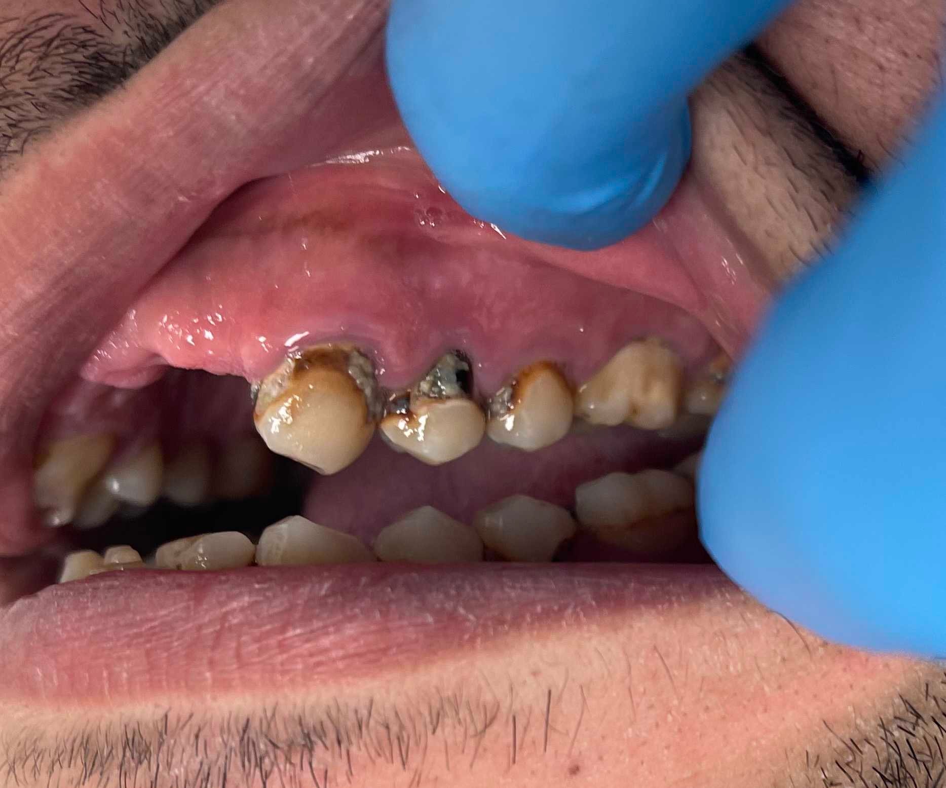 Case 2 before dental treatment